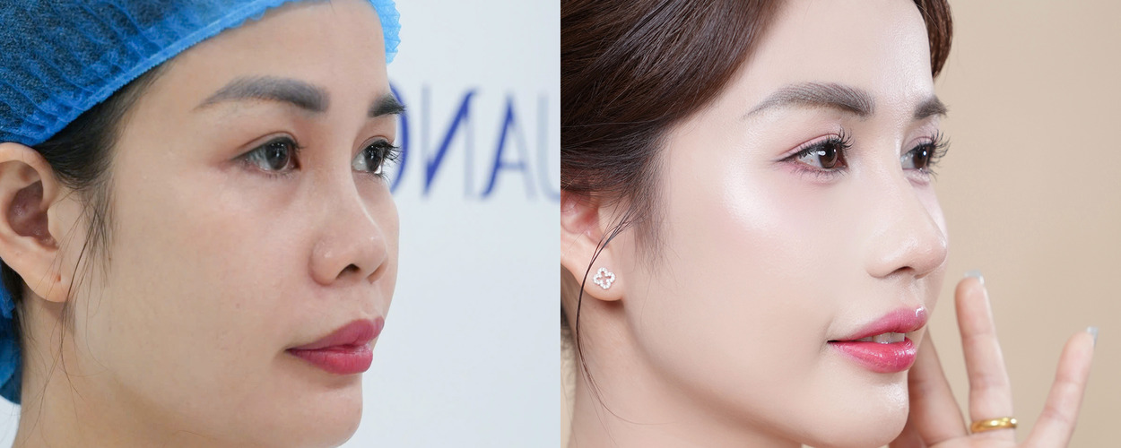 2. NÂNG MŨI CẤU TRÚC SOFTLINE 2