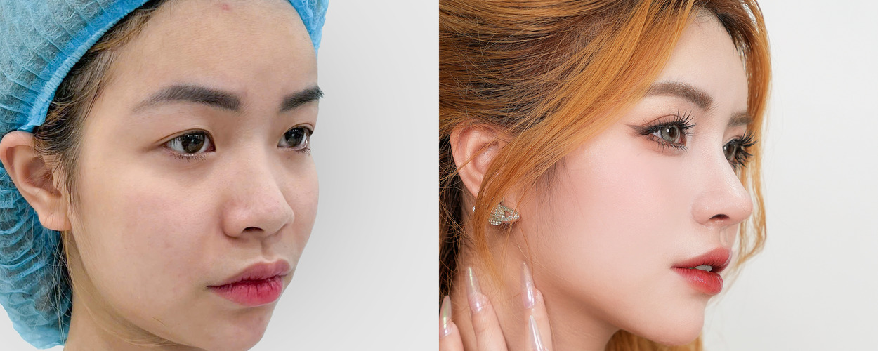 3. NÂNG MŨI CẤU TRÚC SOFTLINE 3