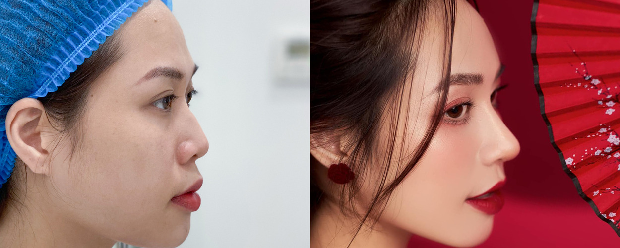 4. NÂNG MŨI CẤU TRÚC SOFTLINE 4