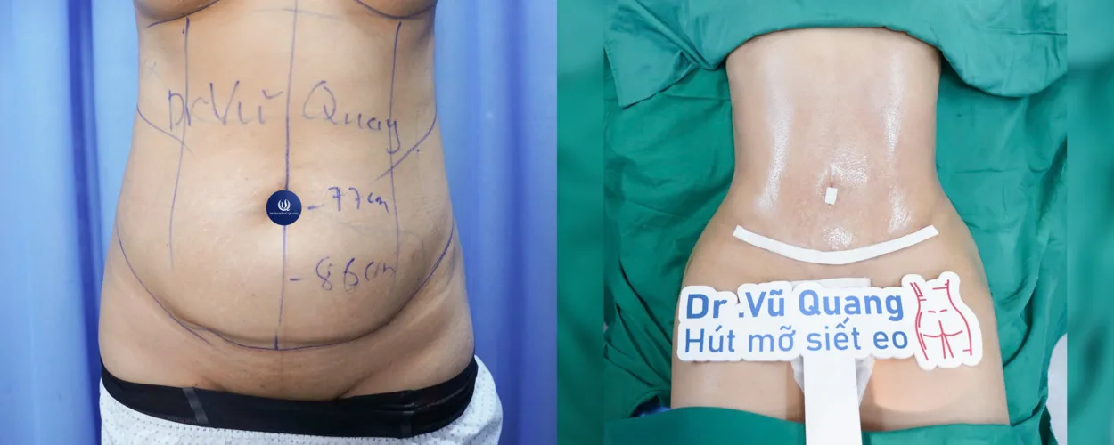 HÚT MỠ BỤNG 1