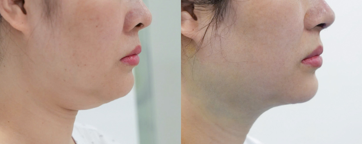 HÚT MỠ NỌNG CẰM 1