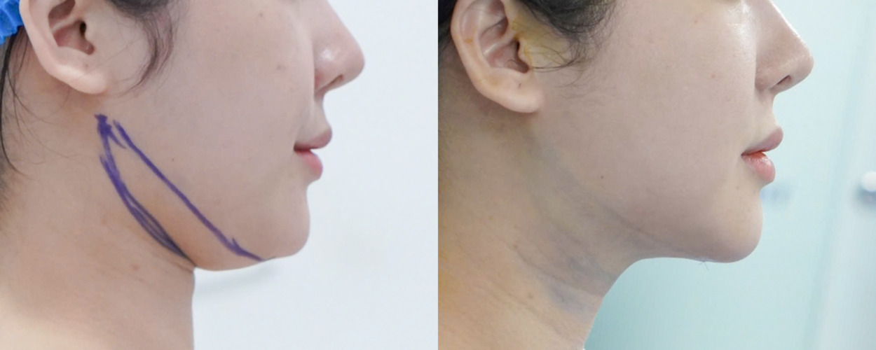 HÚT MỠ NỌNG CẰM 2