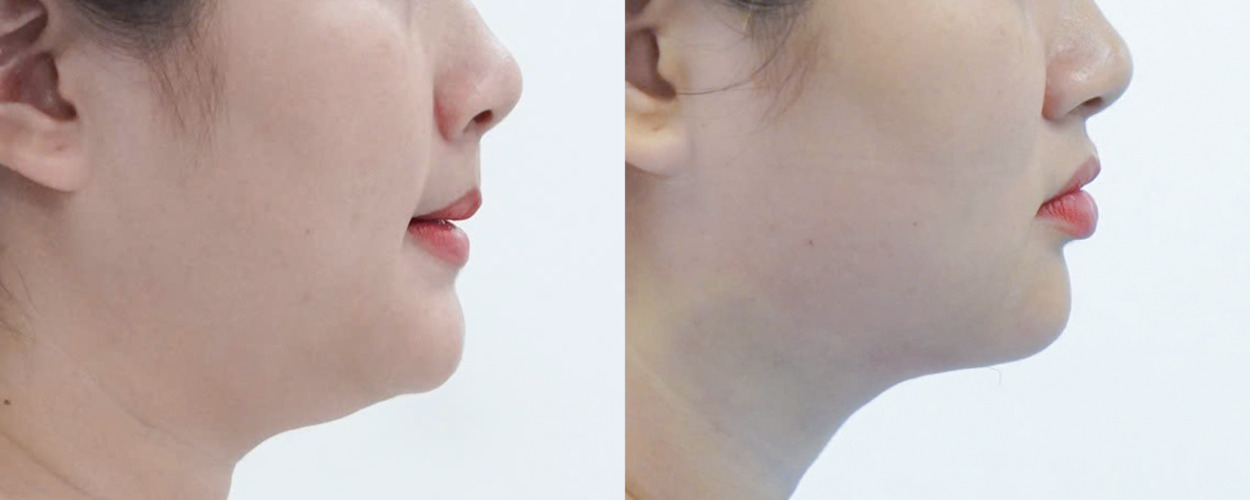 HÚT MỠ NỌNG CẰM 3