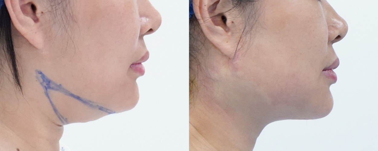 HÚT MỠ NỌNG CẰM 4