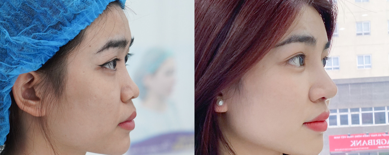 NÂNG MŨI BÁN CẤU TRÚC SOFTLINE 2