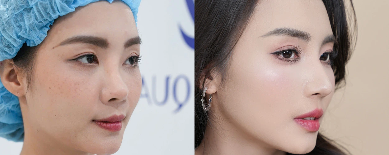 SỬA MŨI CẤU TRÚC SOFTLINE 2